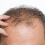 Early baldness: When to do a hair transplant?