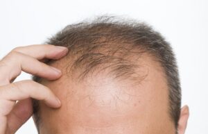 Early baldness: When to do a hair transplant?